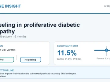 Hormone Insight visual abstract summarising ILM peeling during vitrectomy in proliferative diabetic retinopathy.